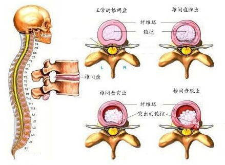 椎间盘滑脱