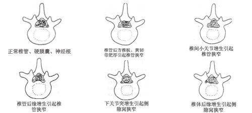 1509958329123561.jpg 椎管狭窄4.jpg