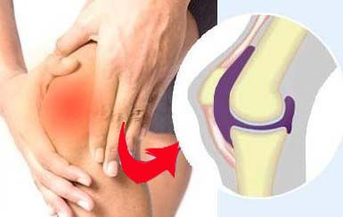 1510044649629382.jpg 滑膜炎.jpg