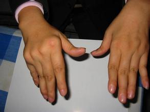 间歇发作型风湿病 间歇发作型风湿病