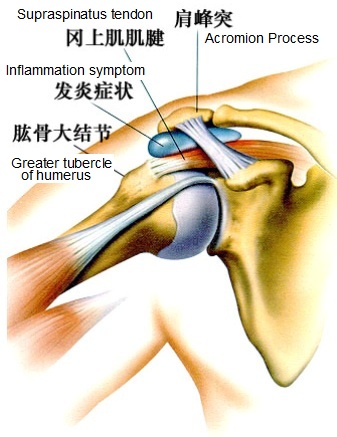 化脓性腱鞘炎 化脓性腱鞘炎