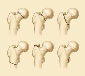 创伤性骨头坏死1 创伤性骨头坏死1