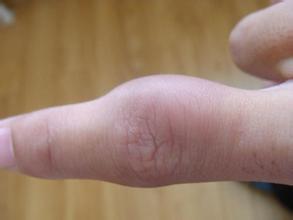 骨质增生的预防要注意保护关节 骨质增生的预防要注意保护关节