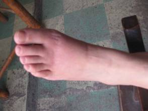 痛风病人锻炼时要注意什么 痛风病人锻炼时要注意什么