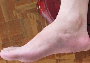 痛风患者如何降低血尿酸水平