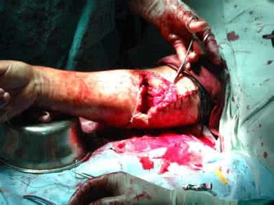 断肢转运2 断肢转运2