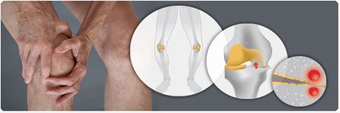 1511243544105668.jpg 骨性关节炎3.jpg