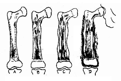 1511245731105075.jpg 骨髓炎治疗.jpg