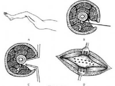 1511252461102630.jpg 骨髓炎的预防.jpg