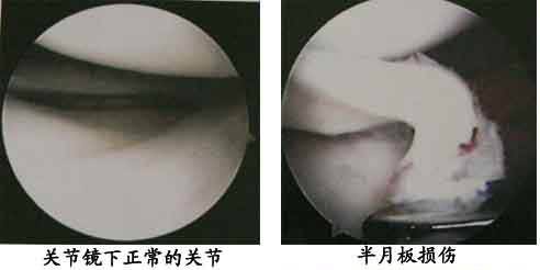 1511684919321748.jpg 半月板损伤14.jpg