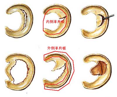 1511685427896782.jpg 半月板损伤18.jpg