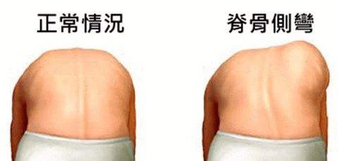 脊柱侧弯 脊柱侧弯
