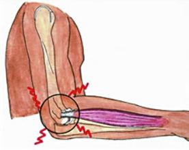有网球肘后怎么做 有网球肘后怎么做
