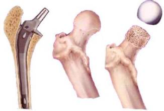 1511836124686356.jpg 股骨头坏死.jpg