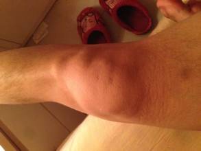 1512007154240547.jpg 半月板损伤.jpg