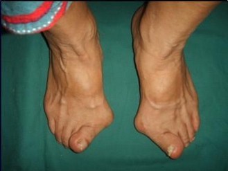 1517111473381648.jpg 拇外翻5.jpg