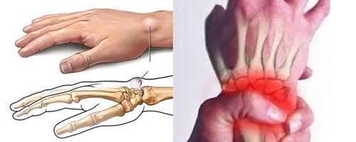 1521097716136440.jpg 腱鞘炎3.jpg