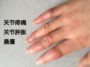 1527382289998595.jpg 手关节肿痛怎么办.jpg