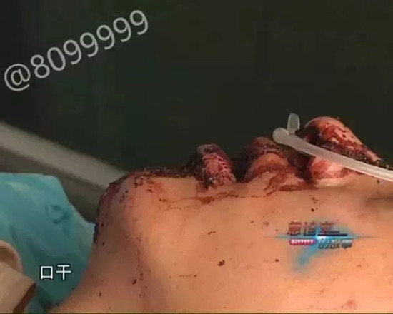 1529547297307246.jpg 抢救中的伤者.jpg