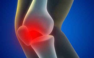 化脓性关节炎 .jpg