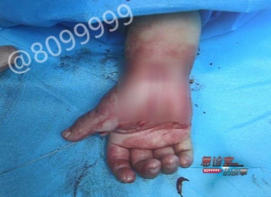 手指情况.jpg