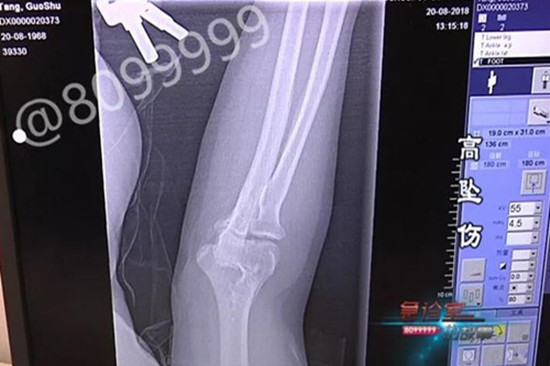 骨折_副本.jpg